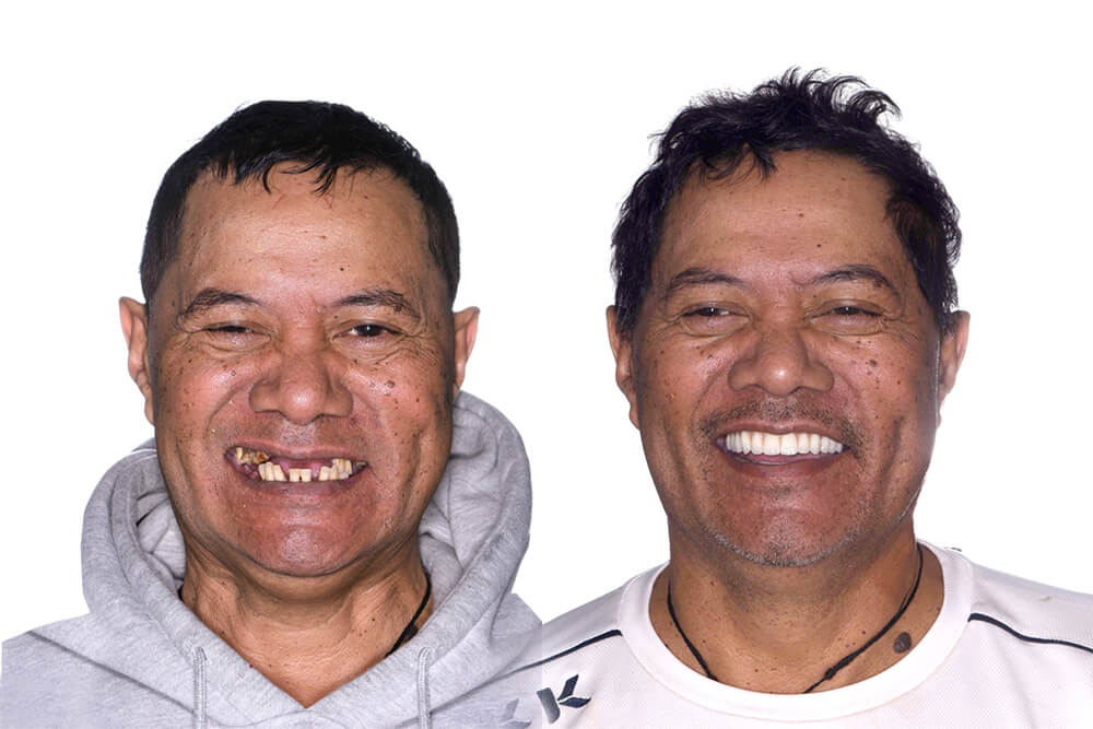 dental implant patient before and after