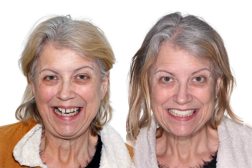 dental implant patient before and after