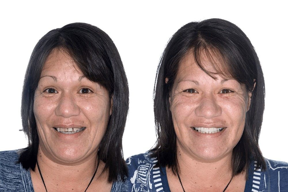 My-Implant-Dentist_Before-After_800x1200mm_Kirii-1