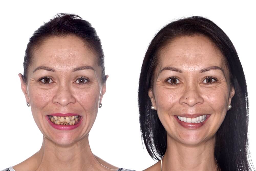 My Implant Dentist dental implants patient before and after