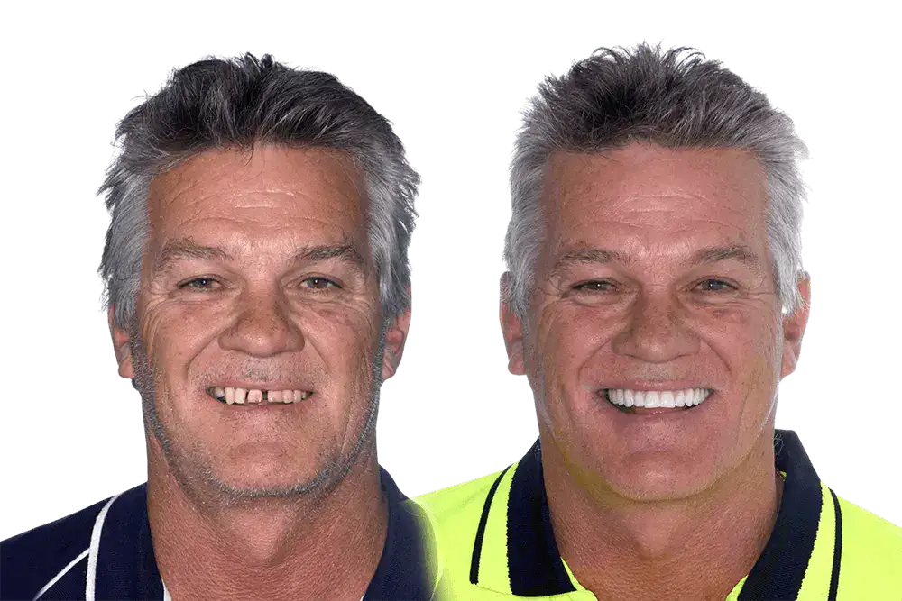 My-Implant-Dentist_Before-After_Mick-Thomas
