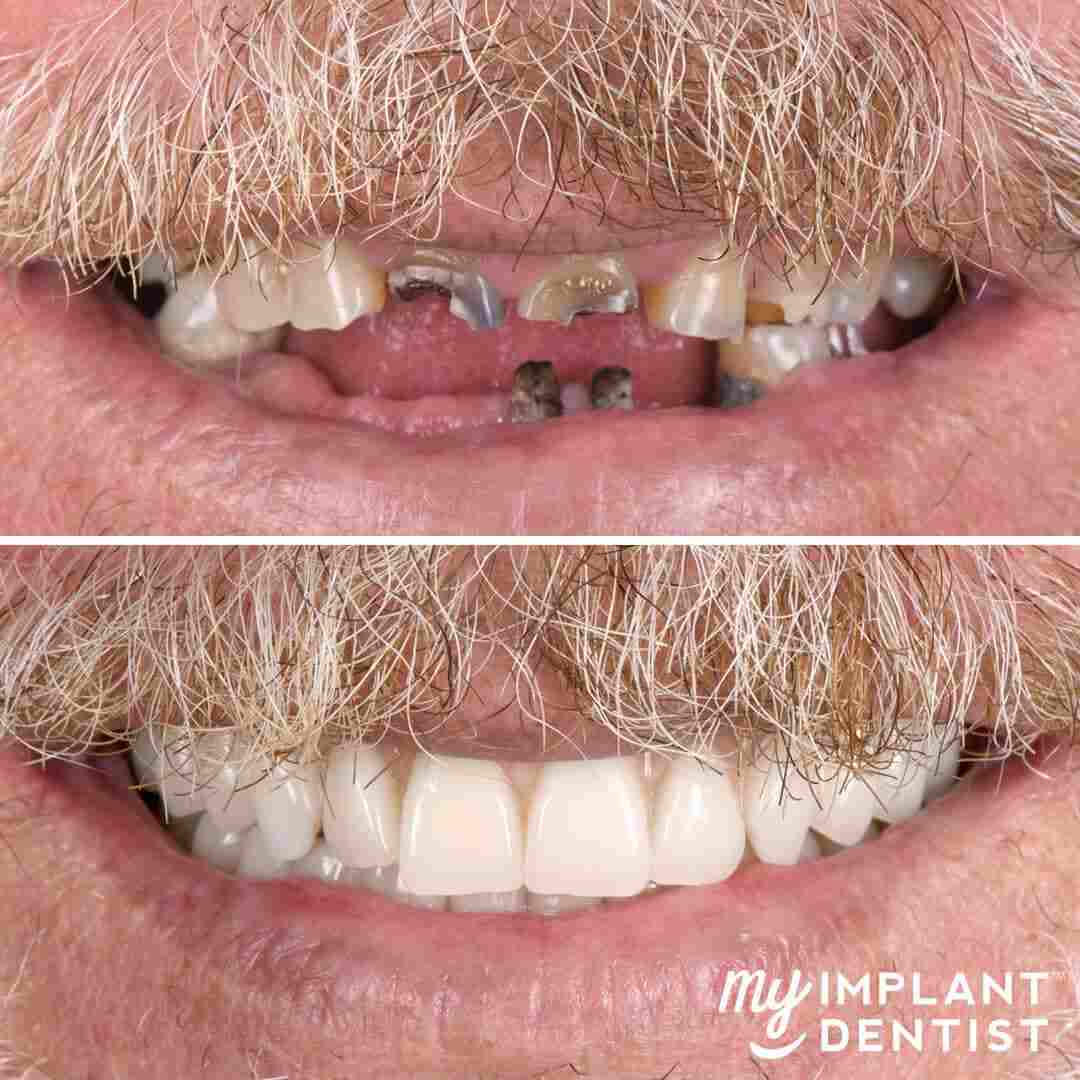 My-Implant-Dentist_Teeth_1080x1080mm_Gordon