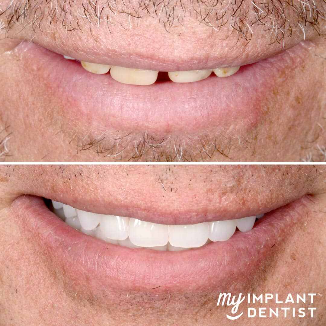 My-Implant-Dentist_Teeth_1080x1080mm_Jason