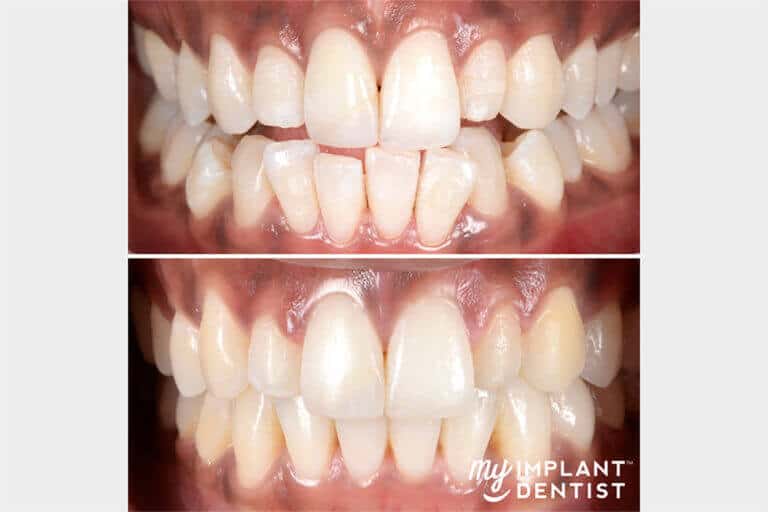 Invisalign Patient Before and After teeth and gums