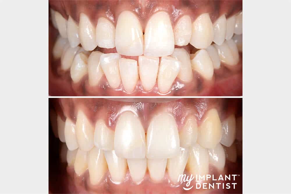 Before and After teeth and gums Patient Kathleen