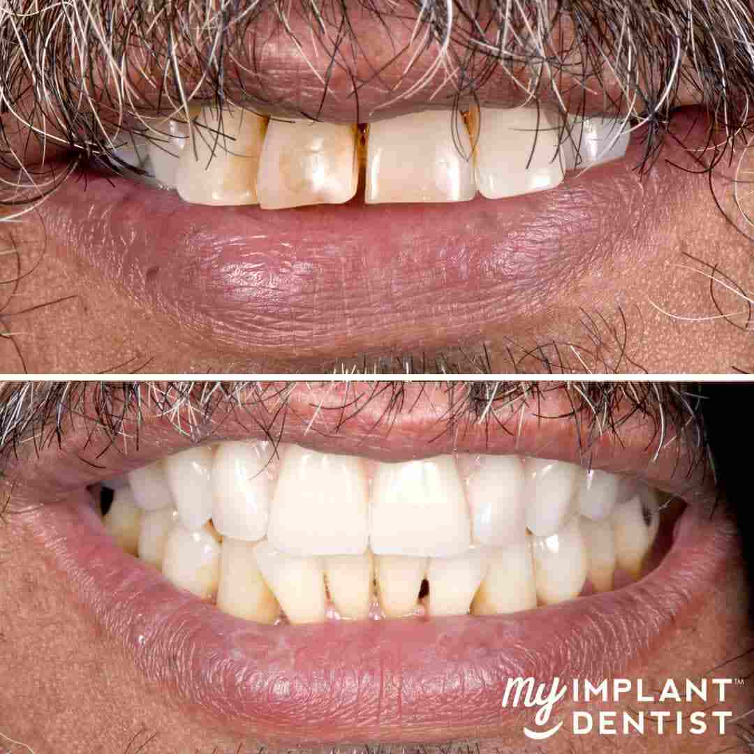 My-Implant-Dentist_Teeth_1080x1080mm_Thomas