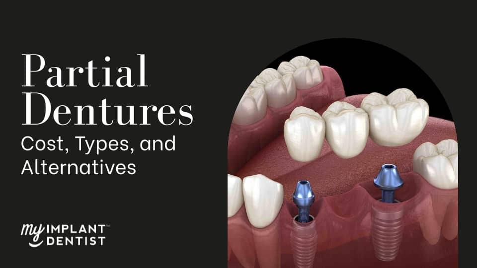 Partial Dentures Cost Types And Alternatives   Partial Dentures My Implant Dentist 