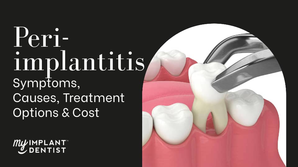 peri implantitis treatment perth cost