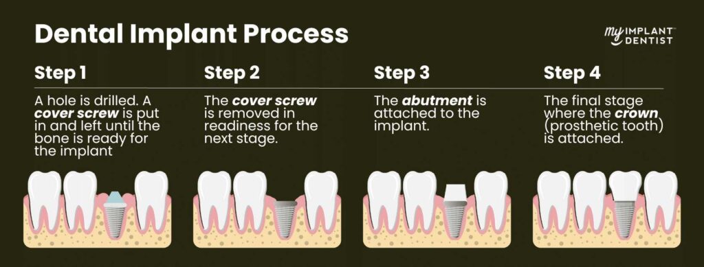 Perth-Tooth-Implant-Procedure