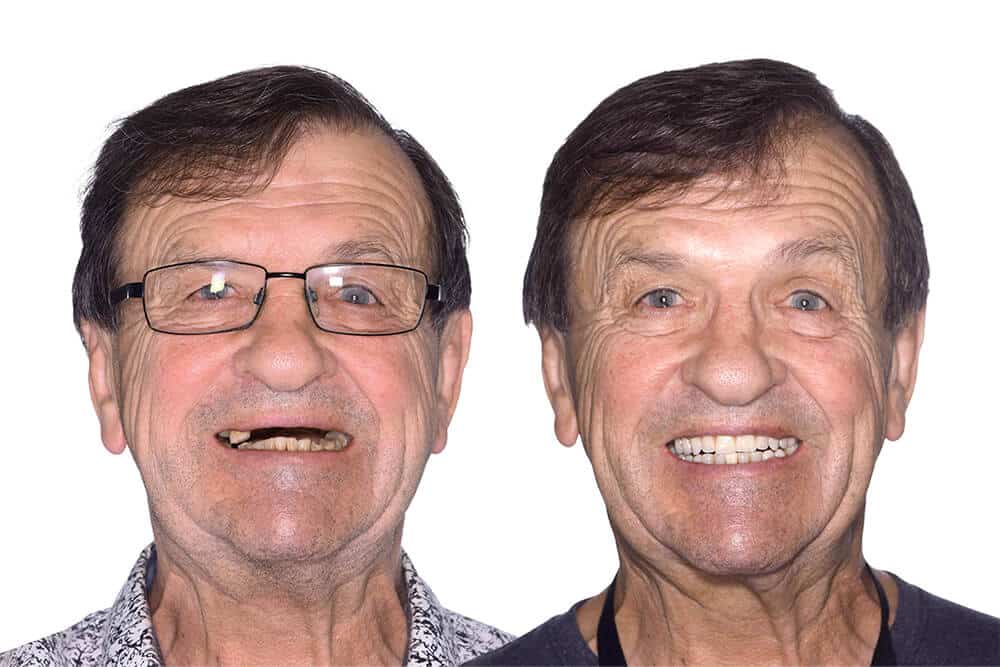 Dental implant patient before and after