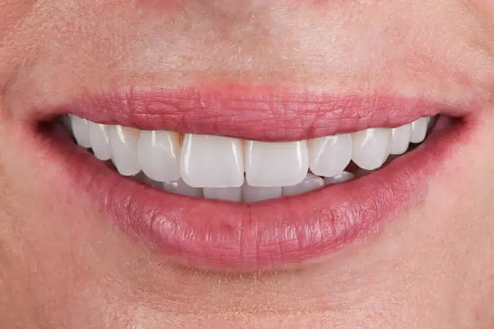 Porcelain Veneers Cost Perth WA