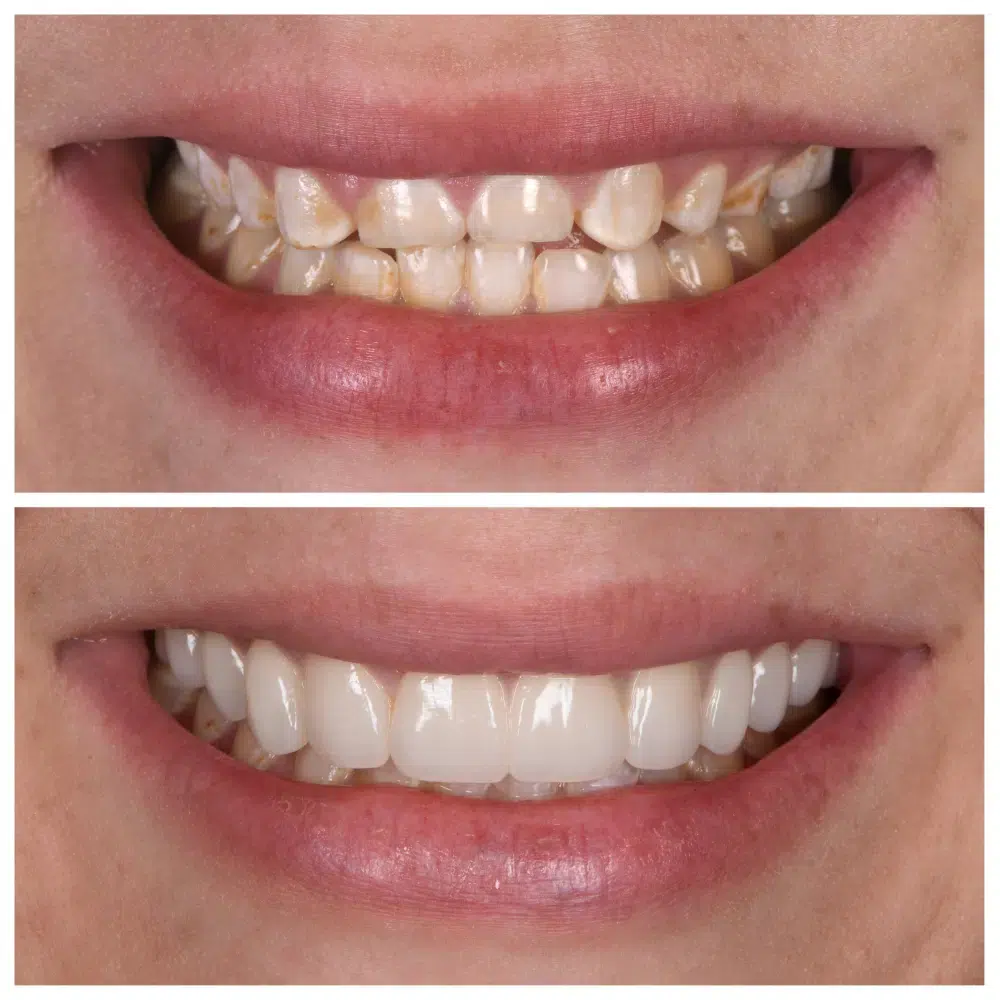 Porcelain Veneers Melbourne