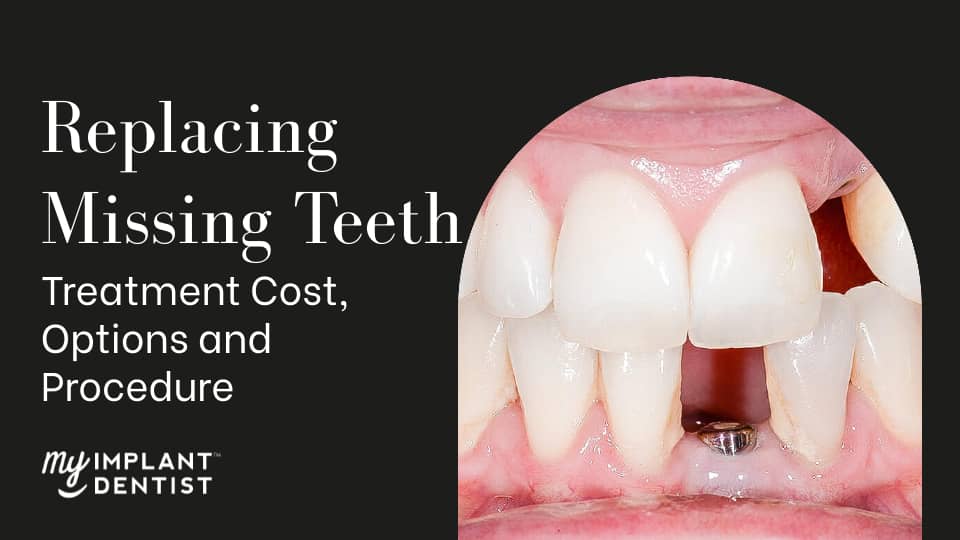 Replacing Missing Teeth - Treatment Cost, Options and Procedure