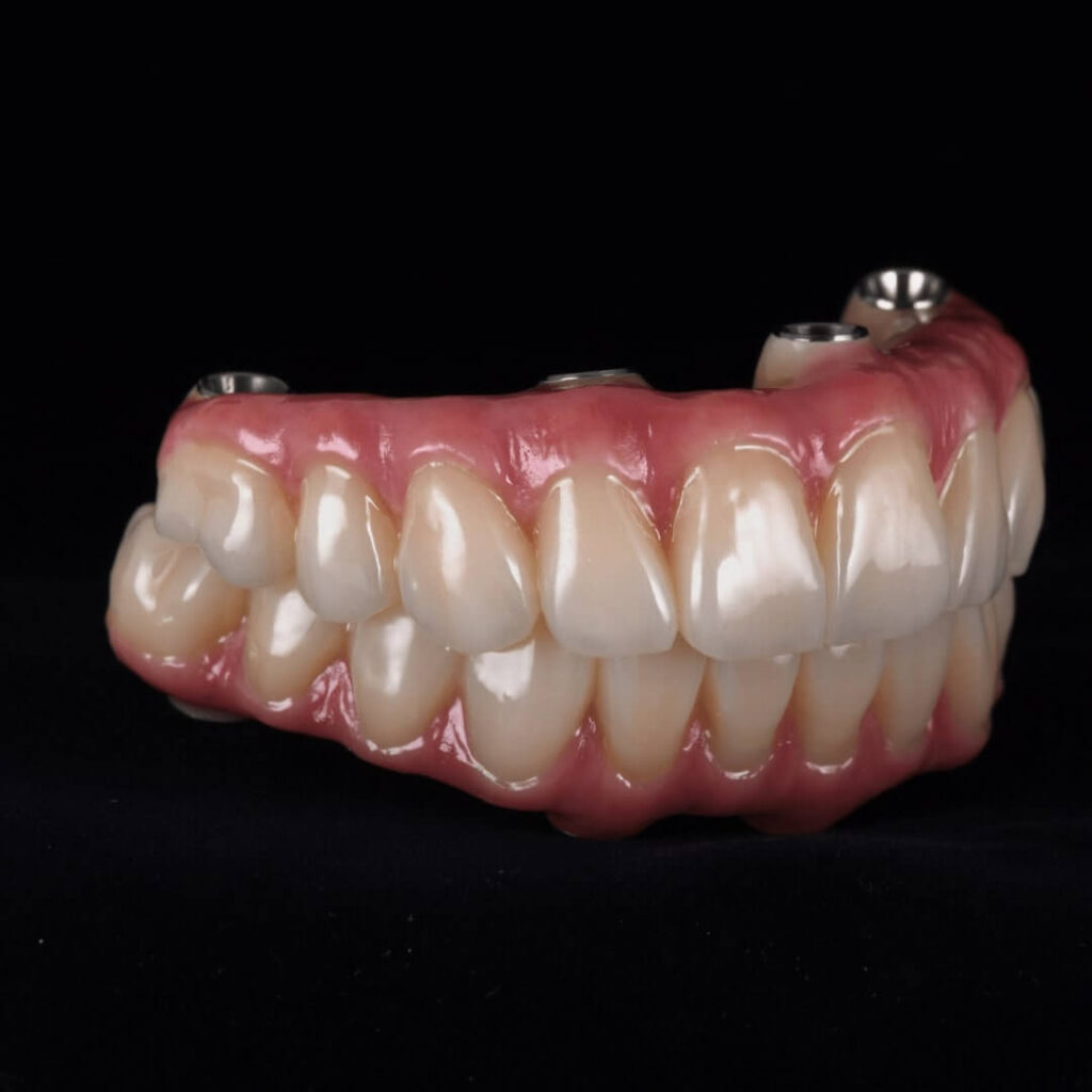 Teeth with Dental Implants