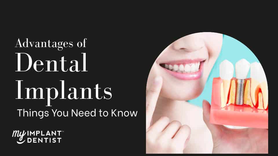 Things You Need to Know Before Getting Dental Implants