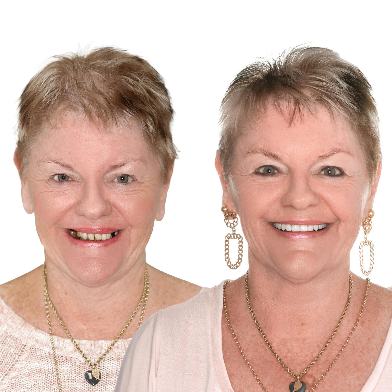 Tooth Implant Financing SuperCare and AfterPay