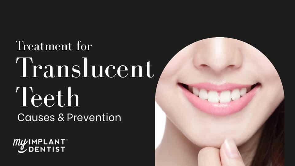 Translucent Teeth - Causes, Treatment & Prevention