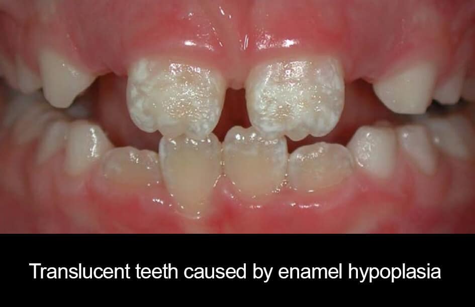 Translucent teeth caused by enamel hypoplasia