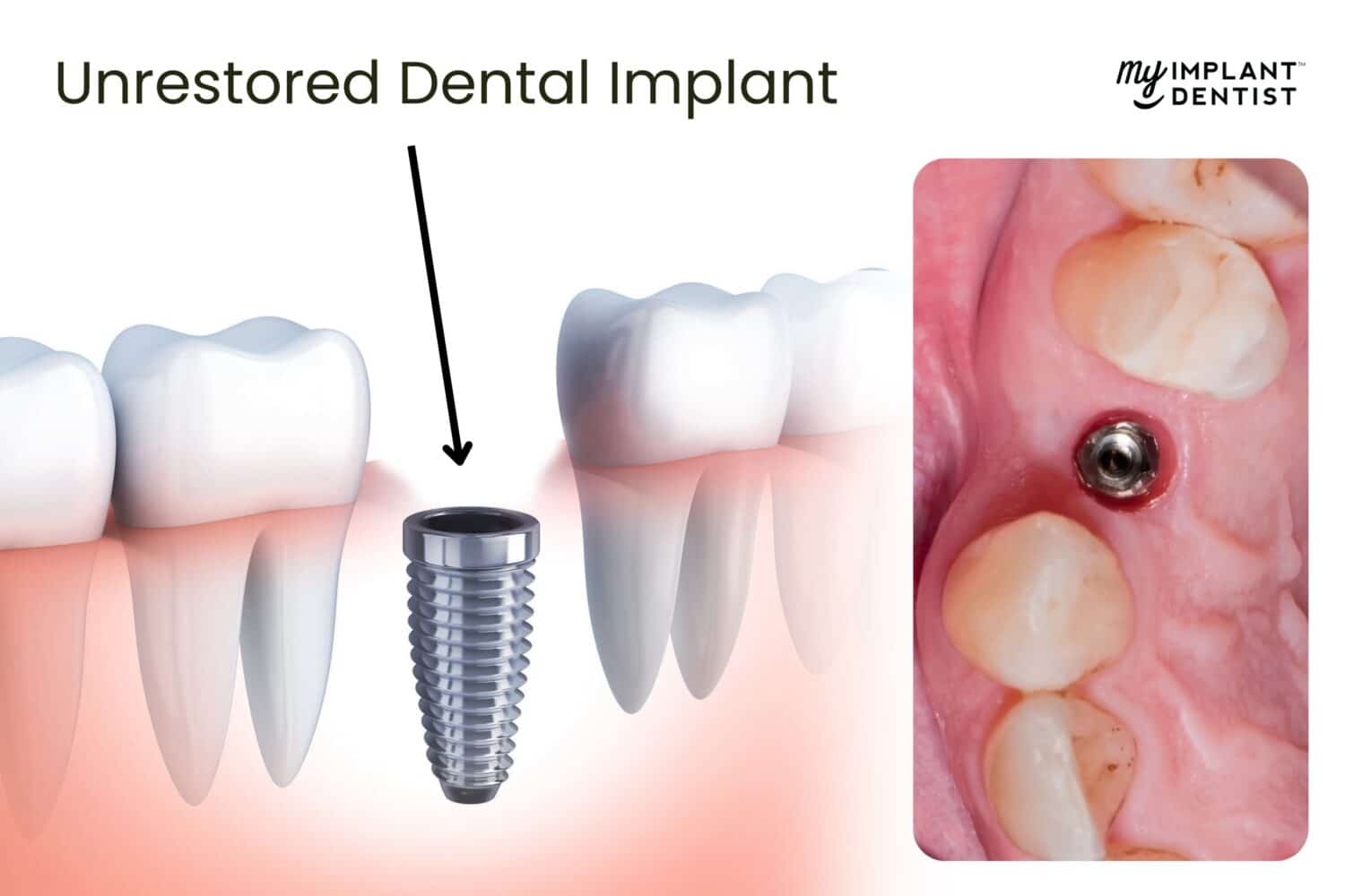 Unrestored Dental Implant Cost Perth