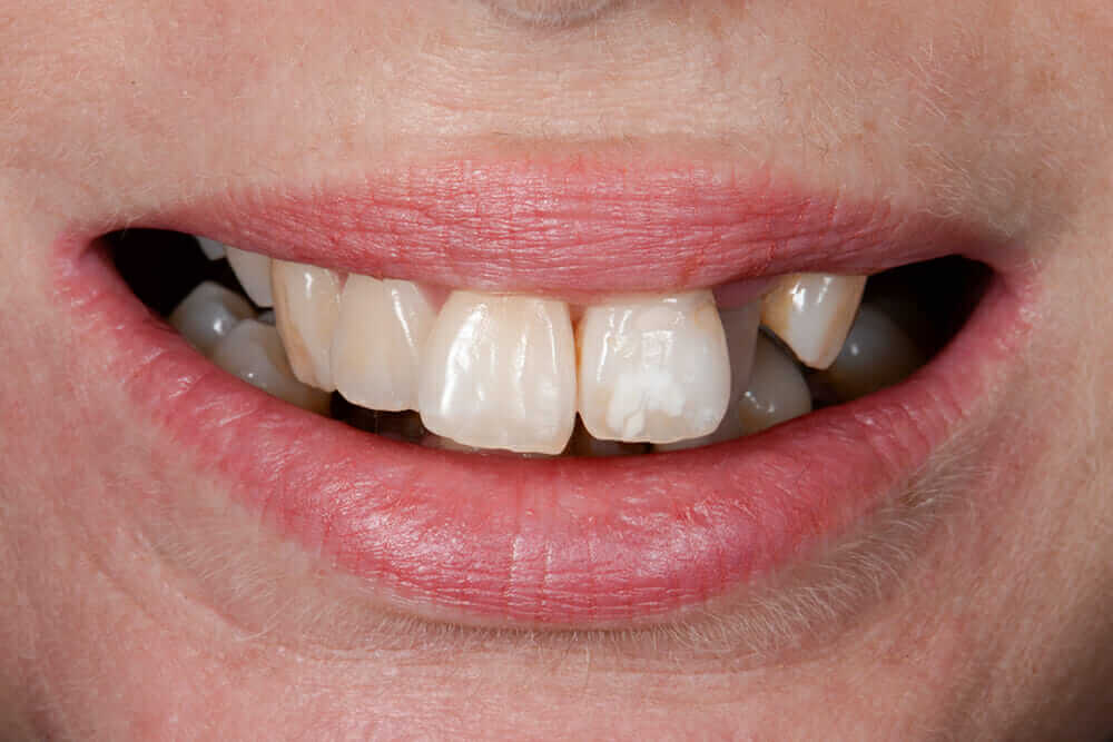 Veneers brisbane
