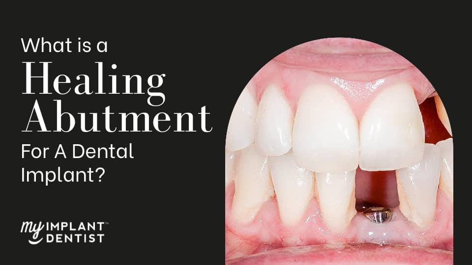 dental implant healing abutment