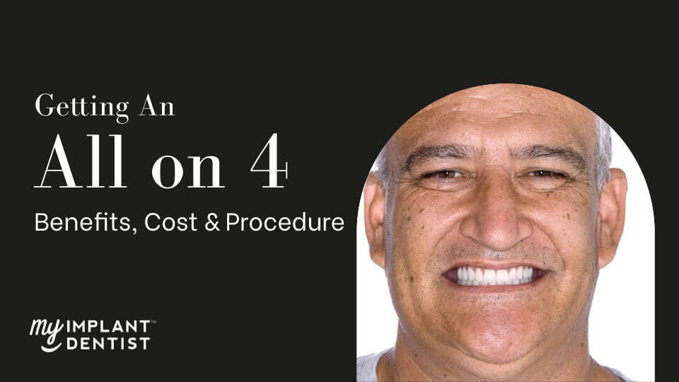 What Is All On Four Dental Implant, And How Does It Work