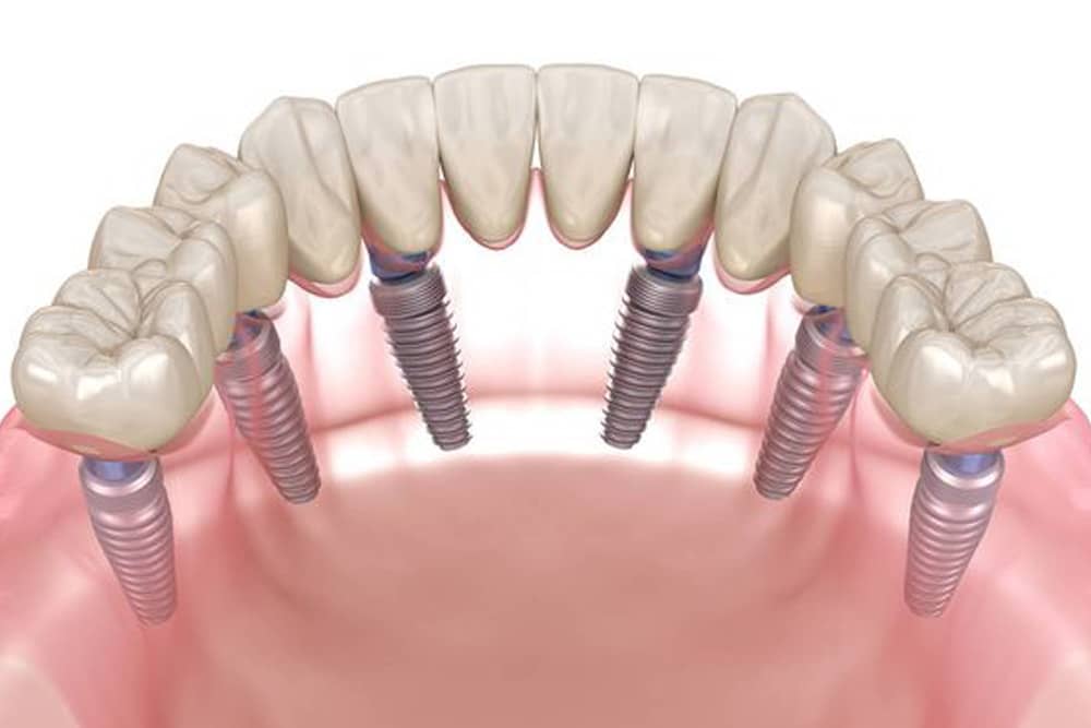 Dental implants in Brisbane