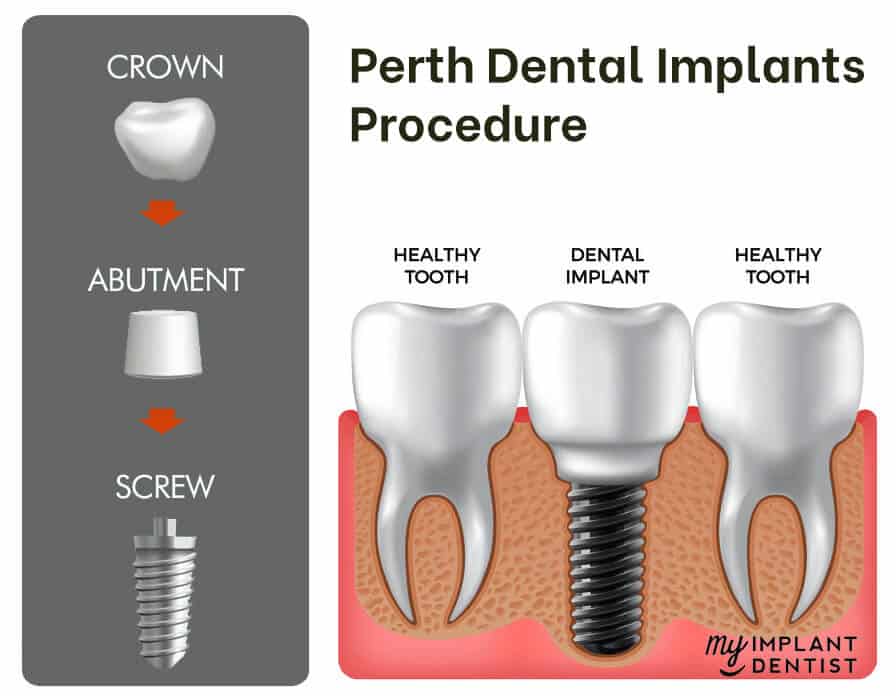 What are Perth Dental Implants
