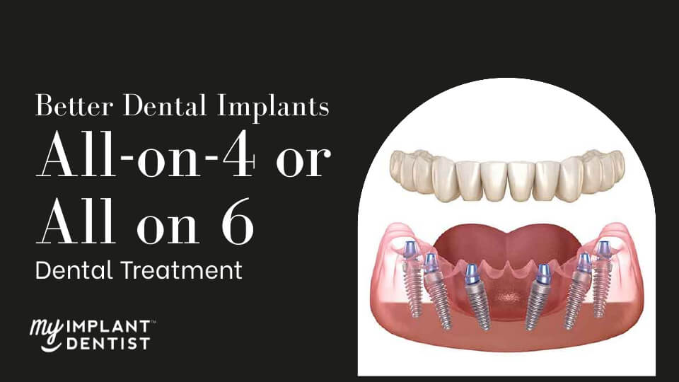 Better All on 4 or All on 6 Dental Implants