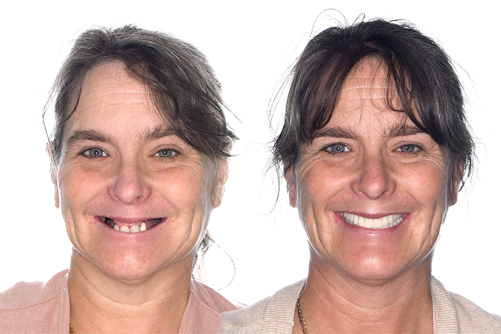 before and after of the All on 4 dental implant patient, happy woman is smiling
