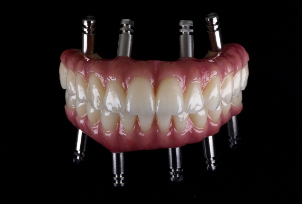 all on 4 dental implants procedure