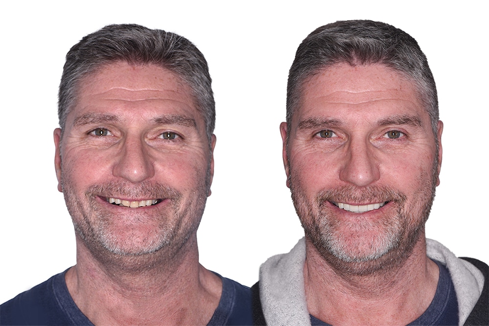 Before and after dental implants Patient