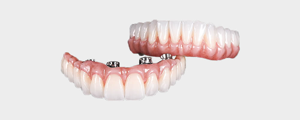 all on 4 dental implants perth