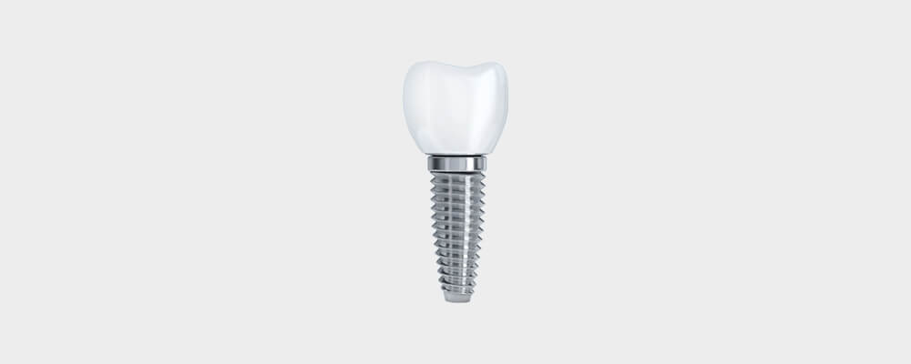Single-Tooth Implants