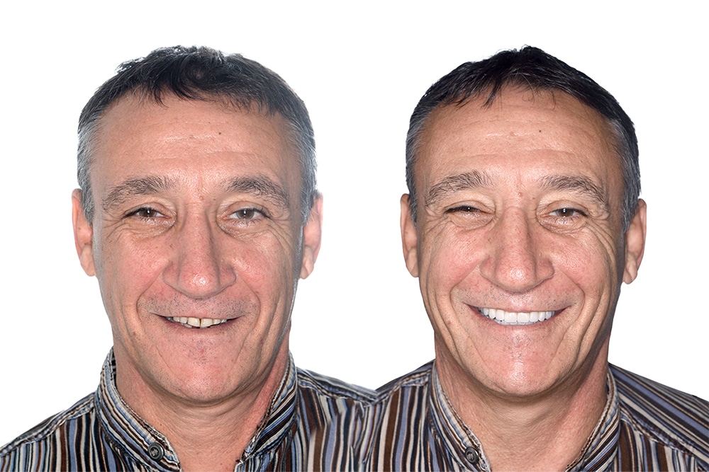 before and after of the all on 4 dental implant patient Bernie