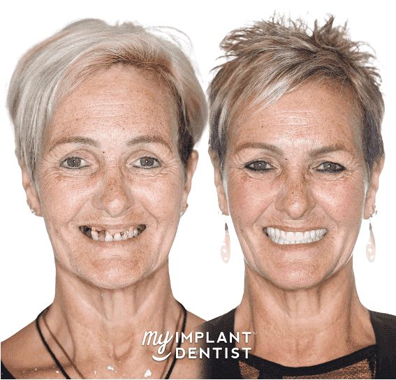 before-and-after-dental-implants-1
