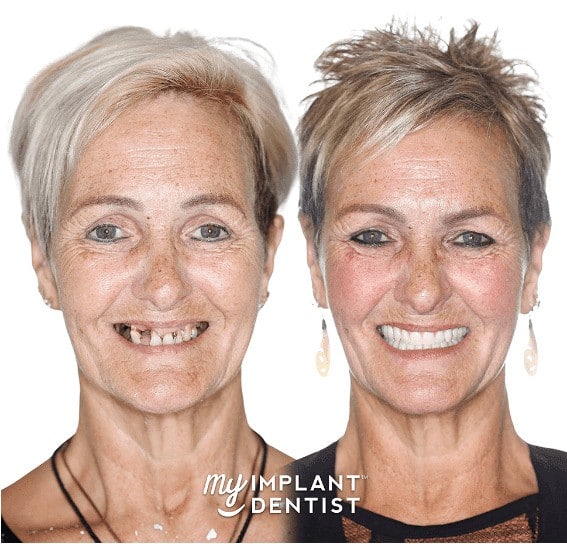 before-and-after-dental-implants