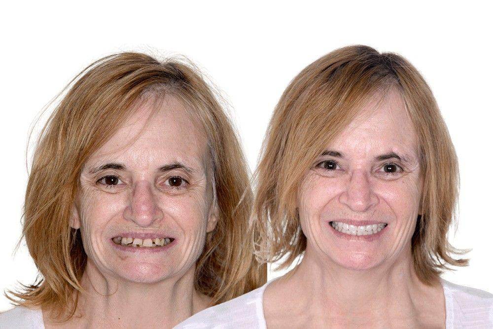 before-and-after-dental-implants_800x1200