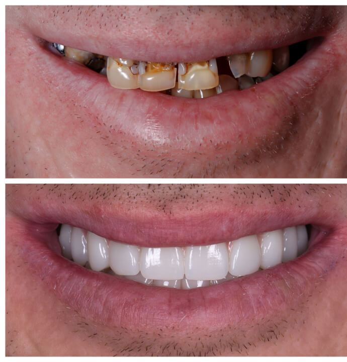best veneers brisbane