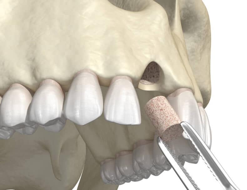 bone grafting for dental implants