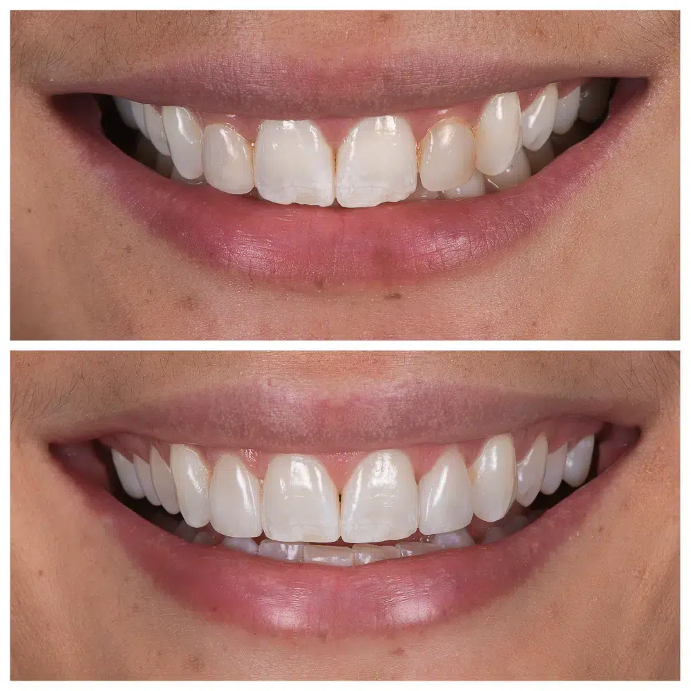 composite bonding melbourne