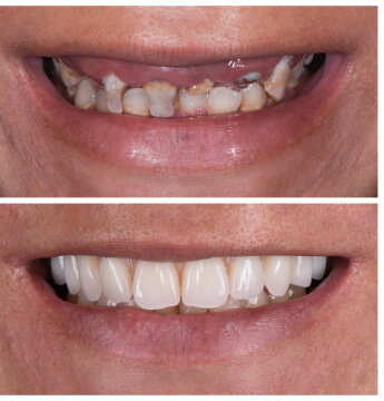 dental bonding brisbane