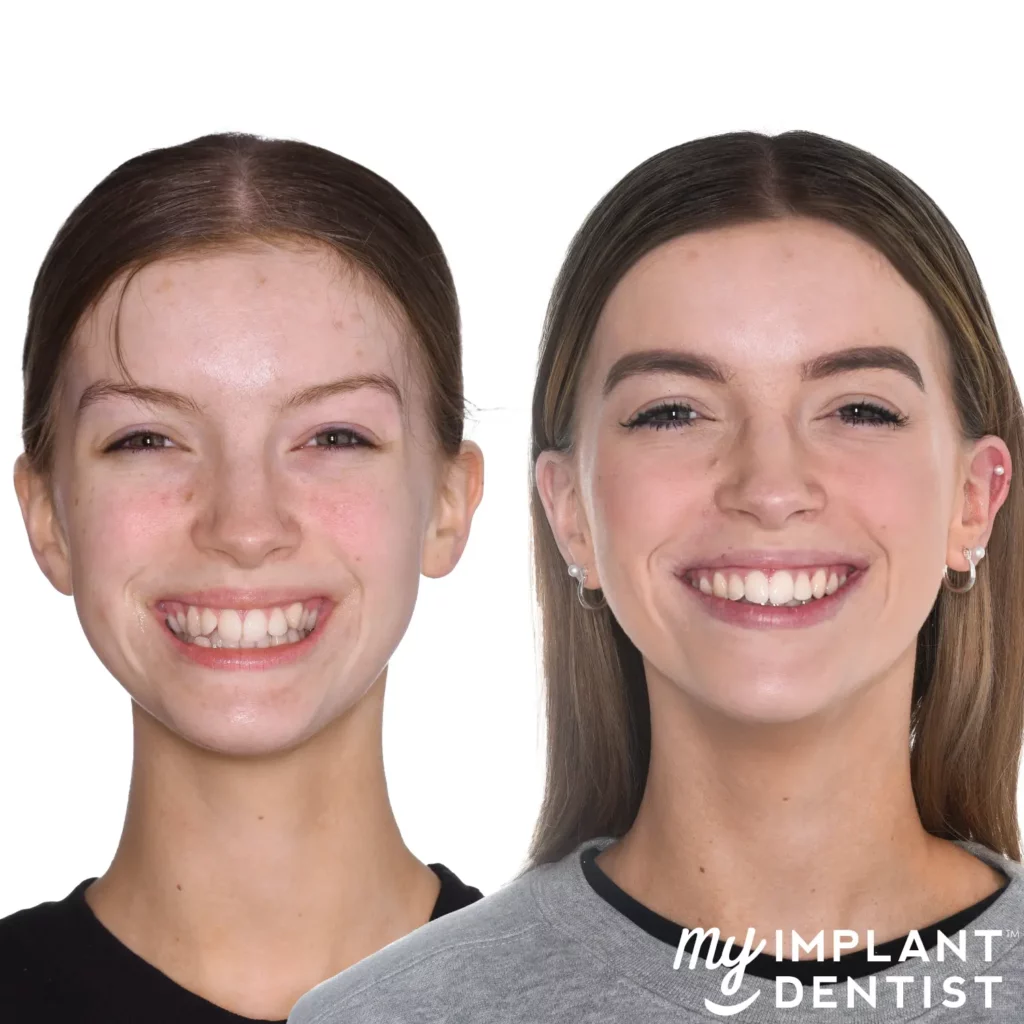 dental implant cost