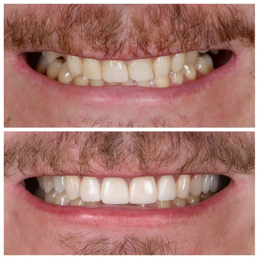 dental veneers melbourne