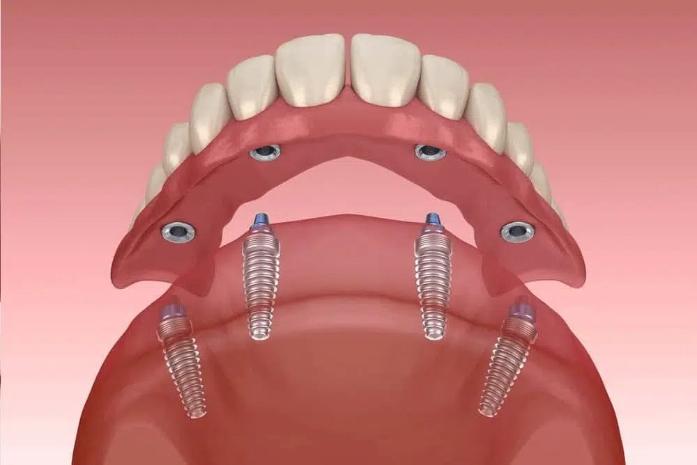Full arch implant supported dentures 
