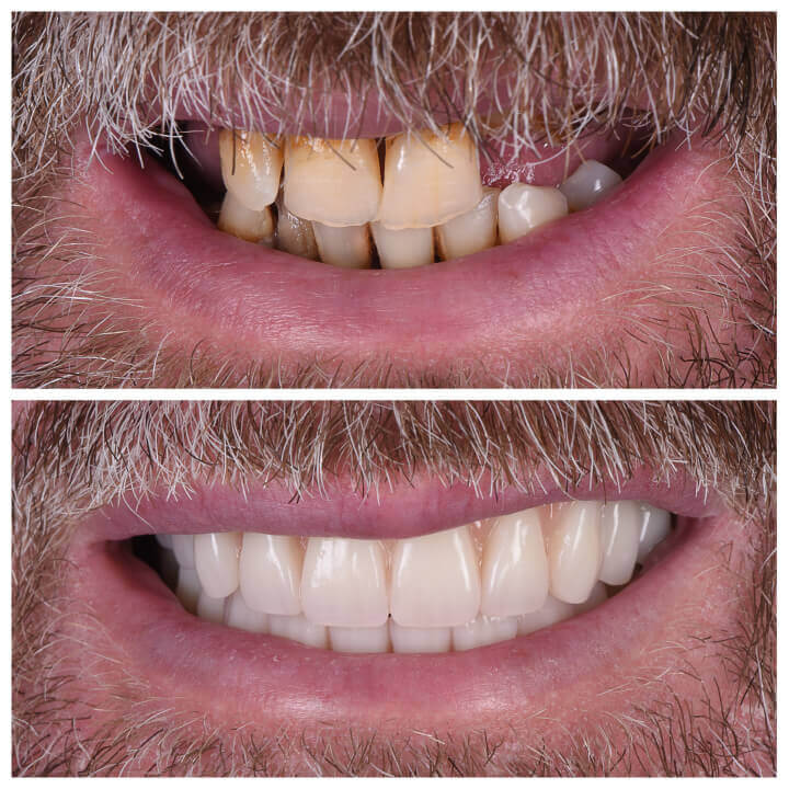 full-mouth-dental-implants-patient-smiles-six
