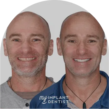dental implants in Perth Before- After