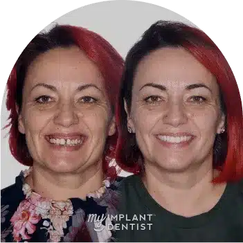 teeth implants Perth Before- After