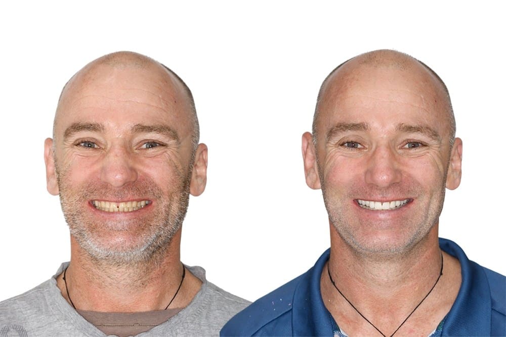 patient-aaron-before-and-after-dental-implants