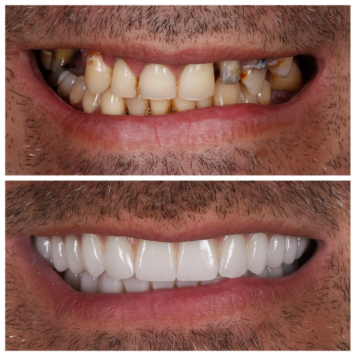 porcelain veneers cost perth